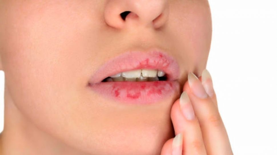 7 Cara Mengatasi Bibir Kering dan Pecah-Pecah dengan Mudah