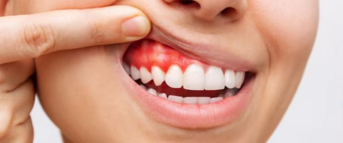 Cara Merawat Gigi agar Terhindar dari Karang Gigi, Gigi Langsung Kinclong!