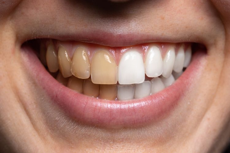 Rahasia Memutihkan Gigi dengan Bahan Alami: Senyuman Lebih Bersinar Tanpa Efek Buatan