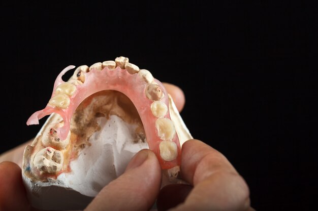 Ini 5 Penyabab Munculnya Karang Gigi dan Cara Mengatasinya