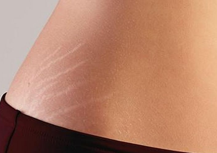 Cara Menghilangkan Stretch Mark dengan Aman