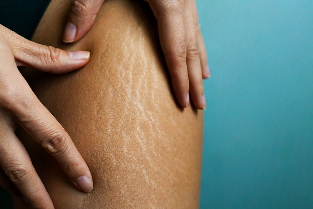 Tips dan Trik Efektif Mengatasi Stretch Mark untuk Kulit yang Lebih Halus