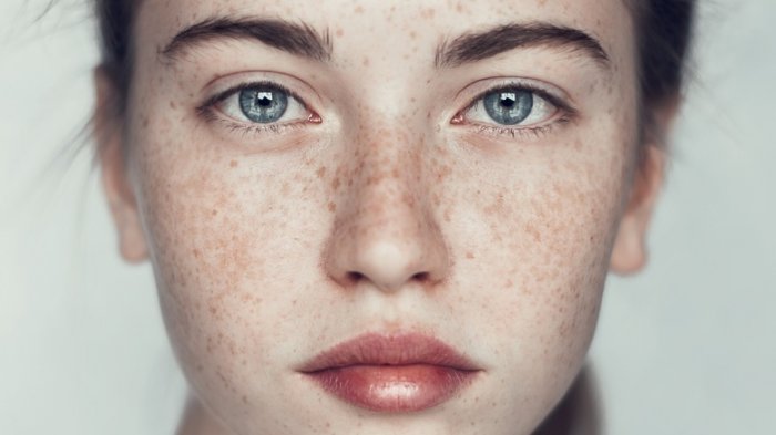 Tips Ampuh Menghilangkan Freckles dengan Mudah