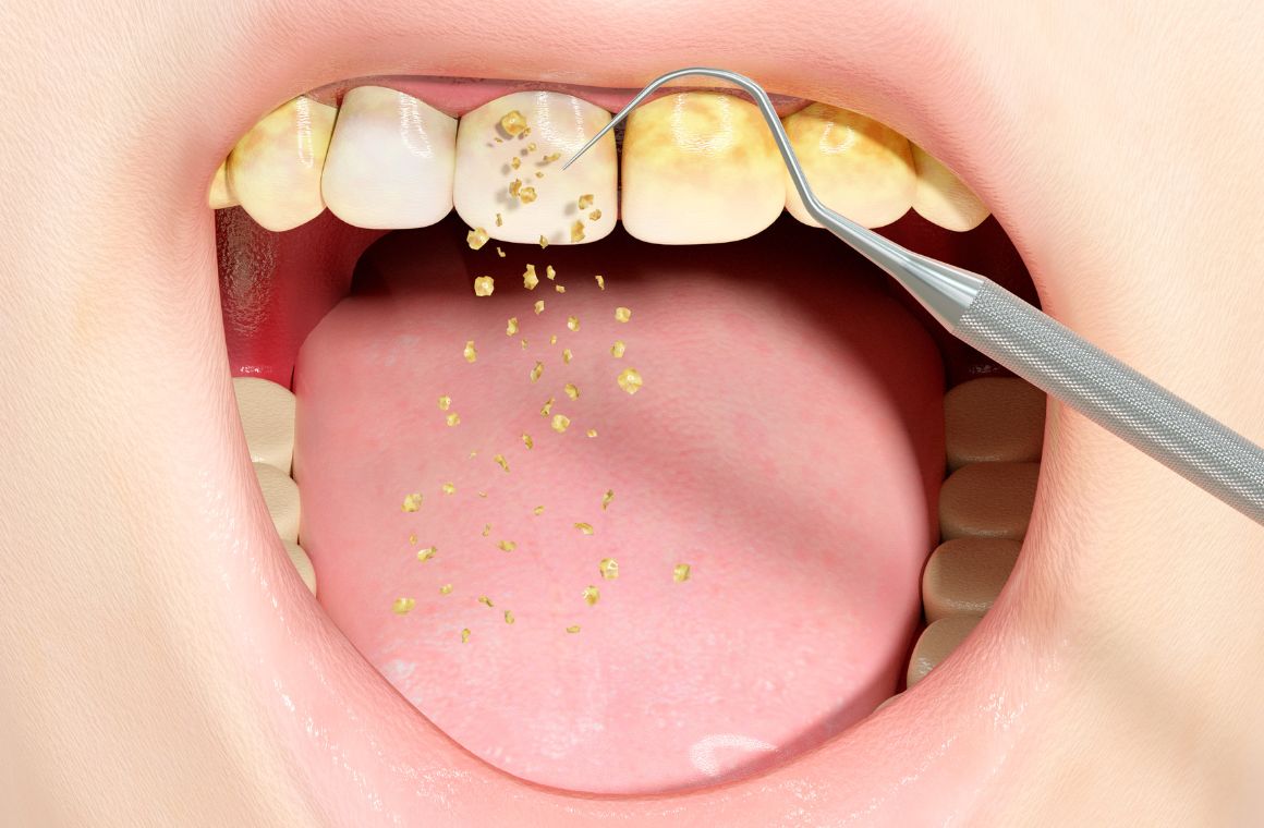 7 Cara Menghilangkan Karang Gigi: Tips dan Metode Efektif untuk Kesehatan Gigi yang Lebih Baik