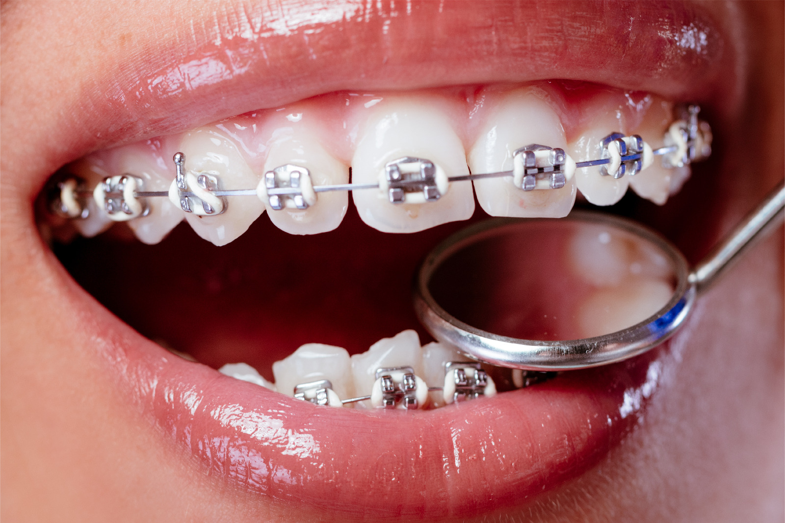 7 Cara Mengatasi Nyeri Gigi akibat Pemasangan Behel Pertama