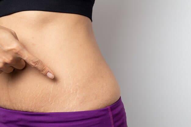 Cara Menghilangkan Stretch Marks dengan Cepat dan Ampuh