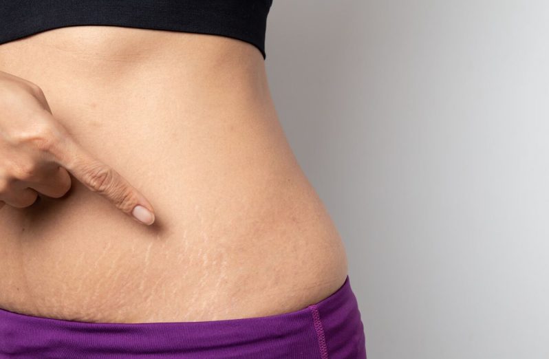 10 Cara Menghilangkan Stretch Mark dengan Metode Alami