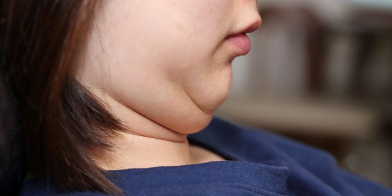 Catat! Inilah 7 Cara Efektif Menghilangkan Double Chin