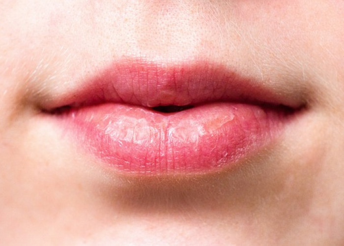 5 Cara Mengatasi Bibir Kering Saat Bulan Puasa   