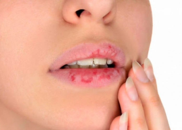 7 Cara Mengatasi Bibir Kering dan Pecah-Pecah dengan Mudah