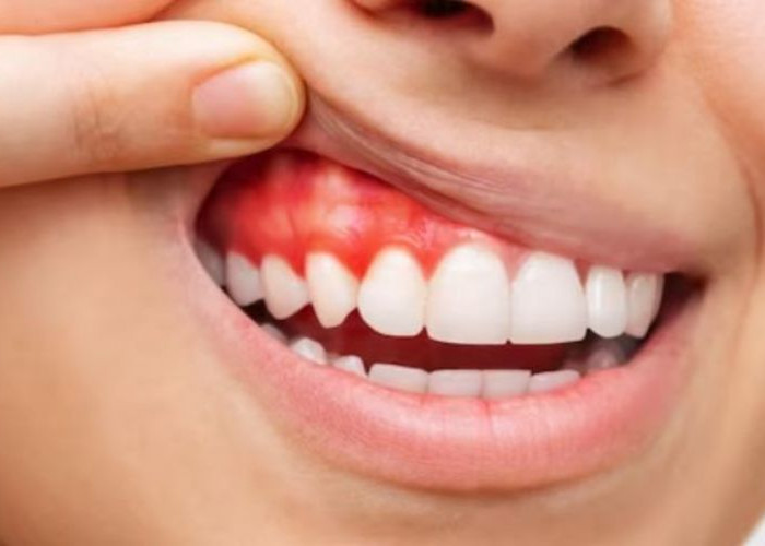 Cara Merawat Gigi agar Terhindar dari Karang Gigi, Gigi Langsung Kinclong!