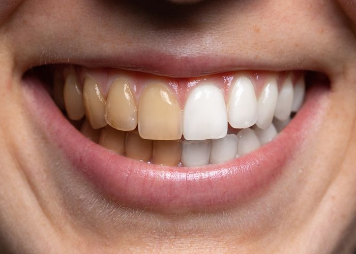 Rahasia Memutihkan Gigi dengan Bahan Alami: Senyuman Lebih Bersinar Tanpa Efek Buatan