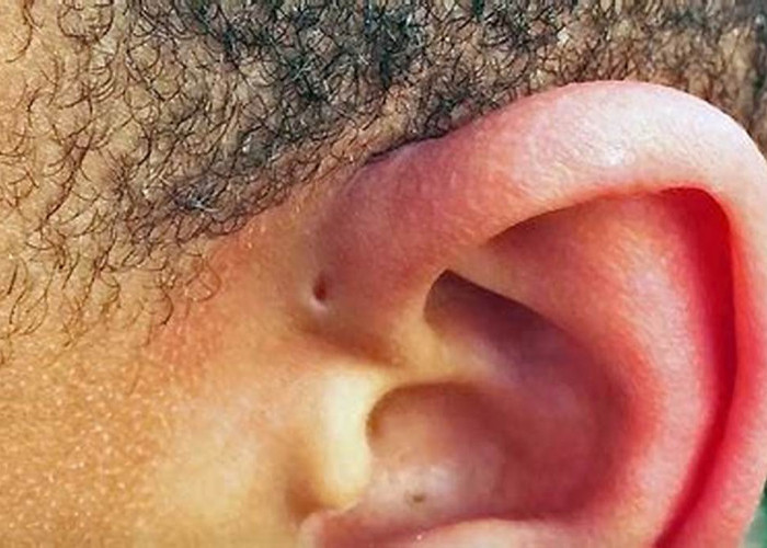 Mengenal Sinus Preauricular