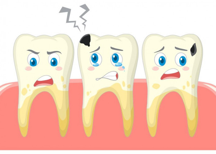 Ternyata Ini Lho 7 Faktor Penyebab Gigi Kamu Berlubang