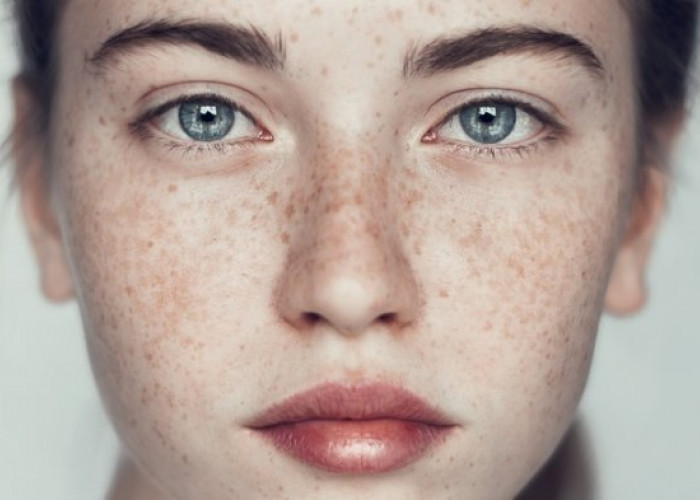 Tips Ampuh Menghilangkan Freckles dengan Mudah