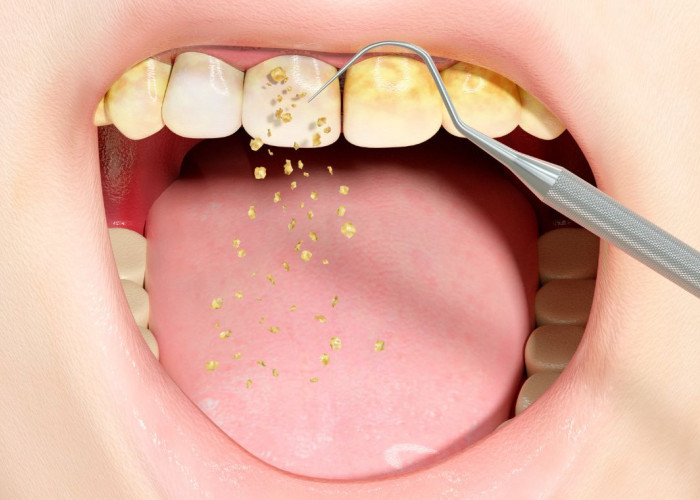 7 Cara Menghilangkan Karang Gigi: Tips dan Metode Efektif untuk Kesehatan Gigi yang Lebih Baik
