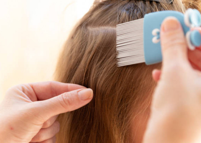7 Tips Cara Mengusir Kutu Rambut dengan Bahan Alami 