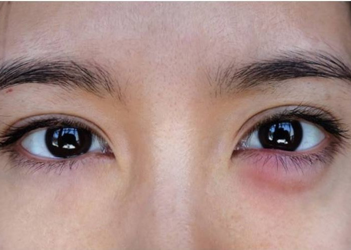 8 Cara Mengobati Mata Bengkak Akibat Nangis: Tips dan Perawatan