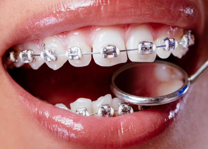 7 Cara Mengatasi Nyeri Gigi akibat Pemasangan Behel Pertama