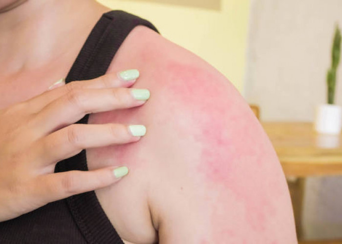 7 Gejala Alergi Panas dan Cara Mencegahnya