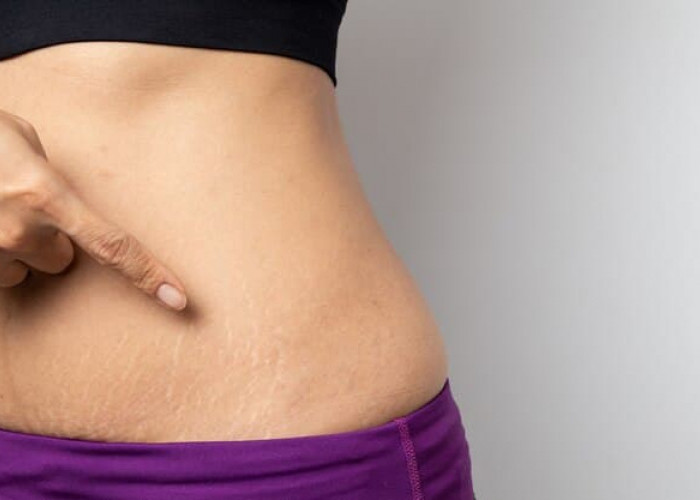 Cara Menghilangkan Stretch Marks dengan Cepat dan Ampuh