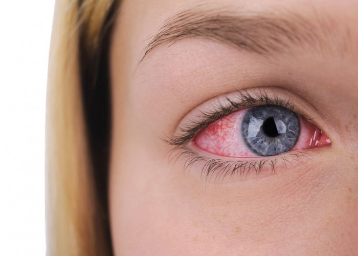 10 Cara Menghilangkan Sakit Mata Akibat Soflens