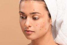 Jerawat Kecil Bisa Jadi Masalah Besar Kalau Salah Treatment